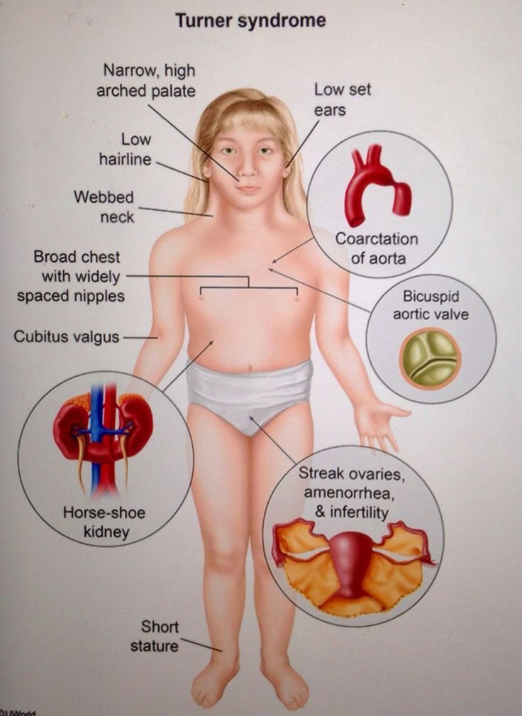 turner syndrome